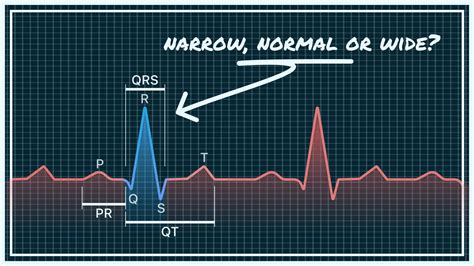 QRS Interval On Your Watch ECG Narrow, Normal, And Wide, 57% OFF