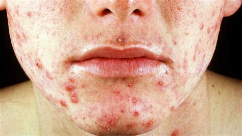 Diese vier Pickelarten sollten Sie niemals ausdrücken | Gesundheit