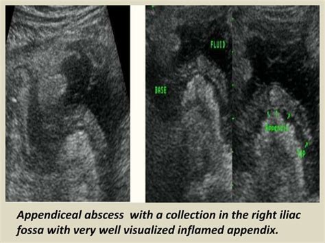 Presentation1 Pptx Ultrasound Examination Of The Appendix Ppt Free Download