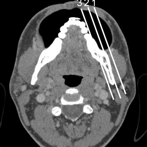 Sagittal Oblique Plane M Masseter Muscle M And Buccinator Muscle