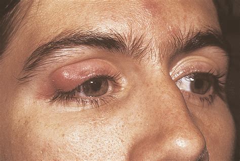 Stye And Chalazion North Texas Eye Center