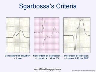 Ecg Lbbb And Acute Mi Ppt