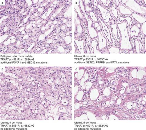 Adenomatoid Tumors Of The Male And Female Genital Tract Are Defined By