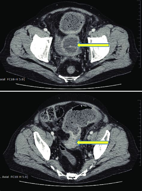 Loculated Collection Around Strictured Sigmoid Colon With Wall Download Scientific Diagram