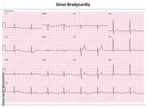 ECG Sinus Bradycardia - ECG Athlete - 12 Leads ECG Paper Stock Photo ...