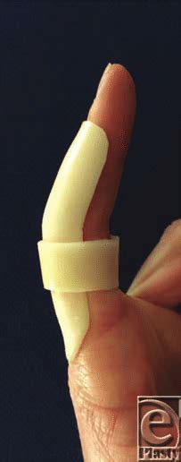 Immobilization of a volar plate injury with an extensionblocking splint... | Download Scientific ...