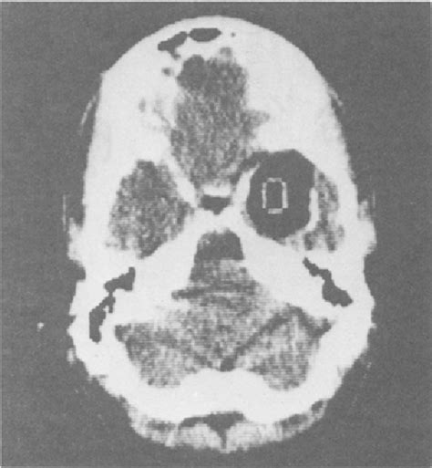 Figure 1 From Preoperative Diagnosis Of A Ruptured Intracranial Dermoid