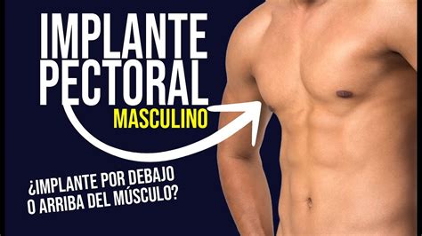 1 IMPLANTE PECTORAL EN HOMBRES Aumenta el TAMAÑO DE TU PECHO