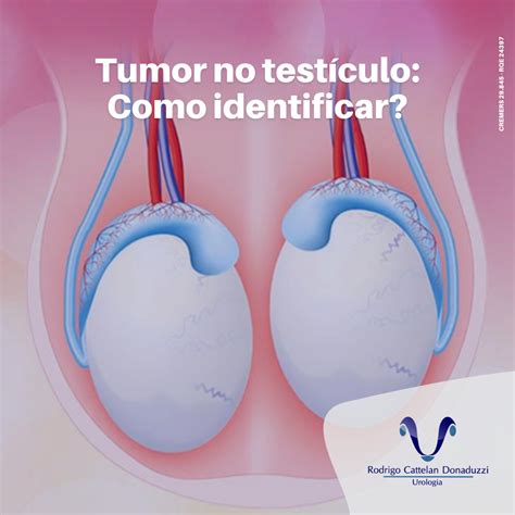 Tumor no testículo Como identificar Rodrigo Donaduzzi