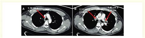 A Contrast Enhanced Computed Tomography Chest Showing Right