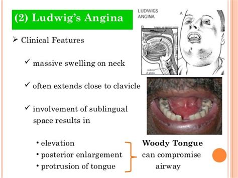 Odontogenic Infections 4