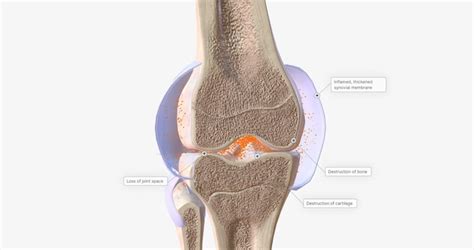 Premium Photo | RA is caused by immune cells attacking the body's own ... 