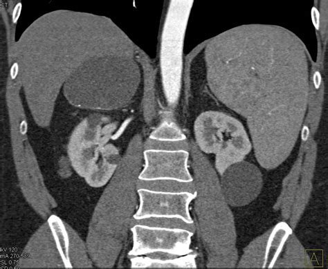 Right Adrenal Cyst With Faint Calcification In The Cyst Wall Adrenal