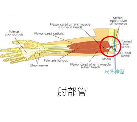 尺骨神経障害 上田整形外科内科