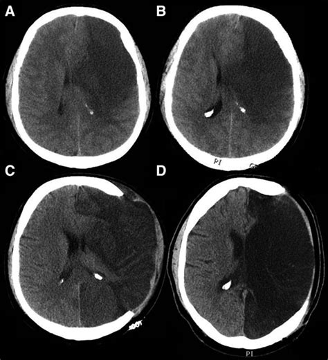 Malignant Hemispheric Infarction Stroke