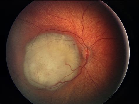 Tumor Intraocular En La Infancia Retinoblastoma Hospital