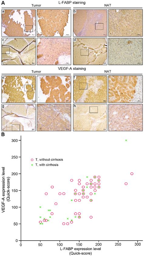 Expression Of L Fabp And Vegf A In Tissues Obtained From Hcc Patients