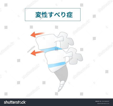 Illustration Spondylolisthesis Symptoms Translation How Degenerative