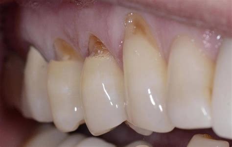 Dental Crowns Alpharetta Ga Before And After