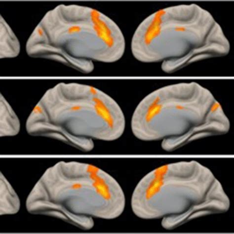 T Maps Of Functional Connectivity With The Sn And Whole Brain In The Download Scientific