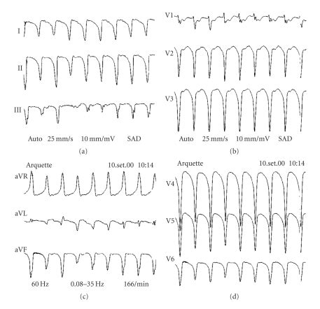 Ventricular Tachycardia With Left Bundle Branch Block Morphology And