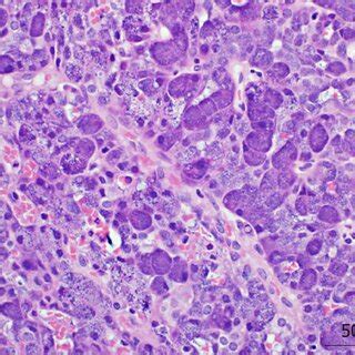 Hematoxylin Eosin Staining Of Low Grade Acinic Cell Carcinoma Images