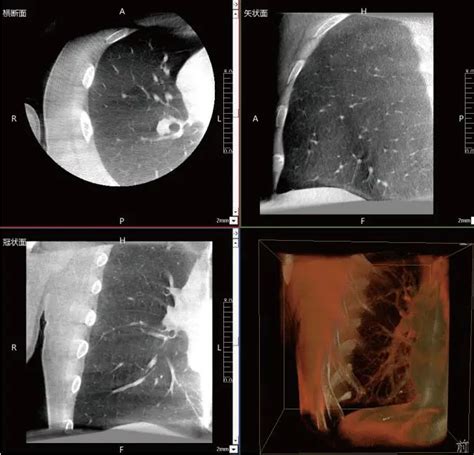 Comparison Between C Arm Ct And Traditional Ct In The Localization And