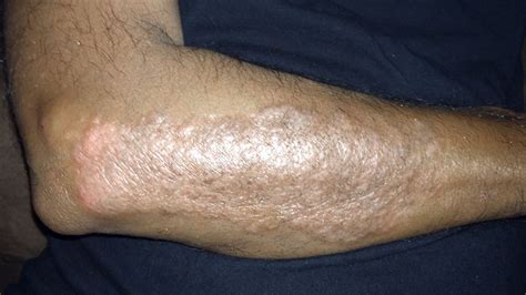 Psoriasis Elbow