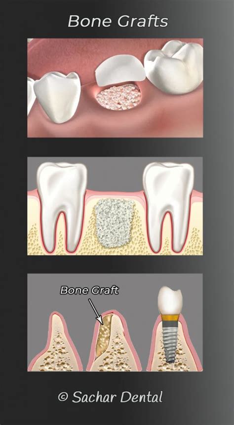 Dental Bone Graft Nyc Manhattan Dental Implant And Bone Graft