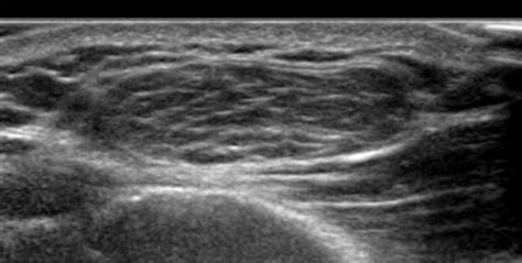 Elastofibroma Dorsi Case Report With Point Of Care Ultrasound Primary