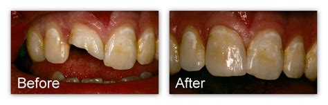 Restoration Of Fractured Teeth Gallery Dr Jack M Hosner D D S