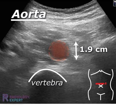 Abdominal ultrasound