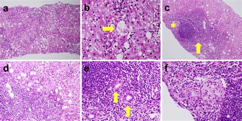 Figure2histology Of Liver Biopsy Specimens A Hematoxylin And Eosin Download Scientific