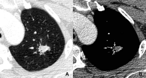 A Patient With Pulmonary Cryptococcosis A And B Axial Ct Images Show Download Scientific