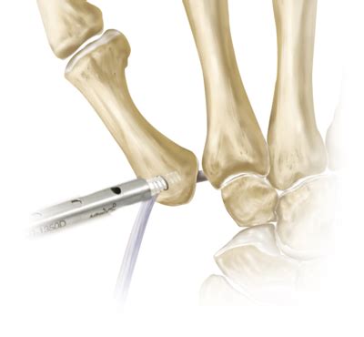 Arthrex - CMC Ligament Reconstruction