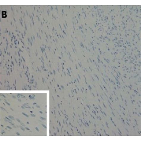 Tumour Cells Stained Positive By In Situ Hybridization With Download Scientific Diagram