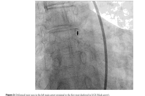 Coronary stent loss-outcomes and their management