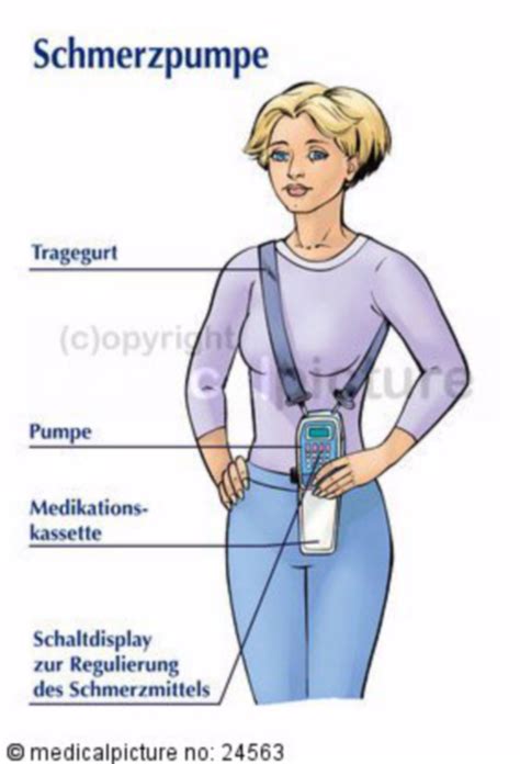 Portable Pain Pump for Chronic Pain Patient - DocCheck