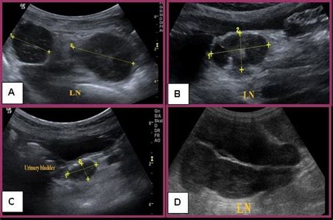 Lymphoma Lymph Nodes Ultrasound