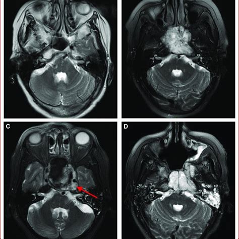 Axial T Weighted Mri Showing A Clival Chordoma Characterized By A High