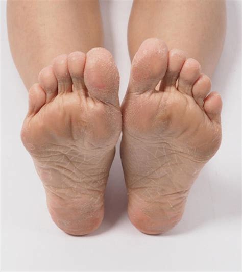 Dead Skin Under Feet Causes Symptoms And Treatment