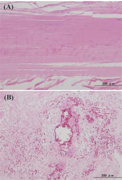 Achilles Tendon Histology