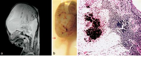 Figure From Less Invasive Autopsy Benefits And Limitations Of The