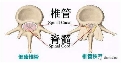 腰椎管狭窄常见问题解答腰椎管狭窄症融合术植骨手术减压 健康界