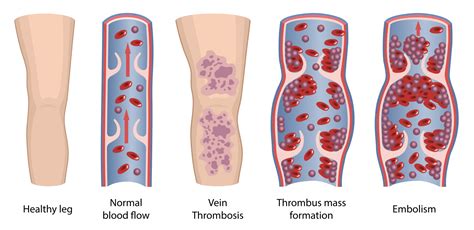 Deep Vein Thrombosis And Blood Clots Treatments In Phoenix Az