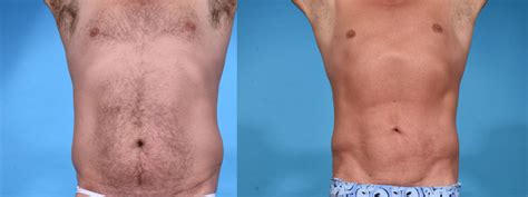 Hi Definition Vaser Lipocontouring And Liposculpting Dr Daniel O Beck