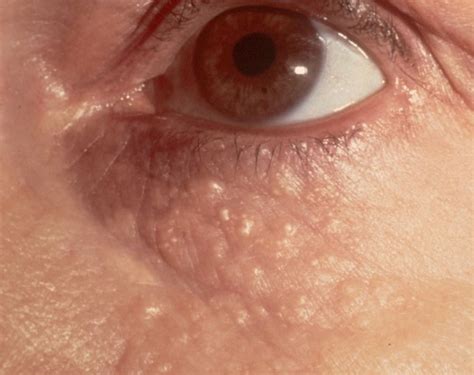 Syringomas Fleshy Or Yellow Bumps On Or Under Eyelids Inskin