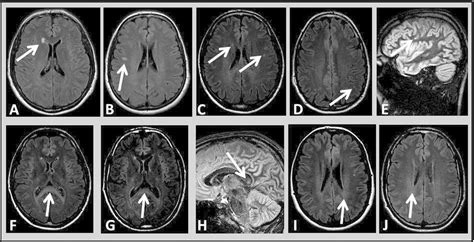 Charcot Triad Of Multiple Sclerosis - 1868 - Multiple Sclerosis is ...