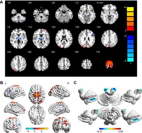 Spontaneous Brain Activity In The Sa And Hc Groups Notes A The