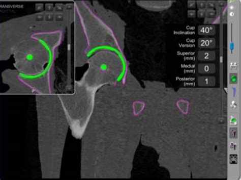 Mako Surgery - Mako Robotic Hip Surgery